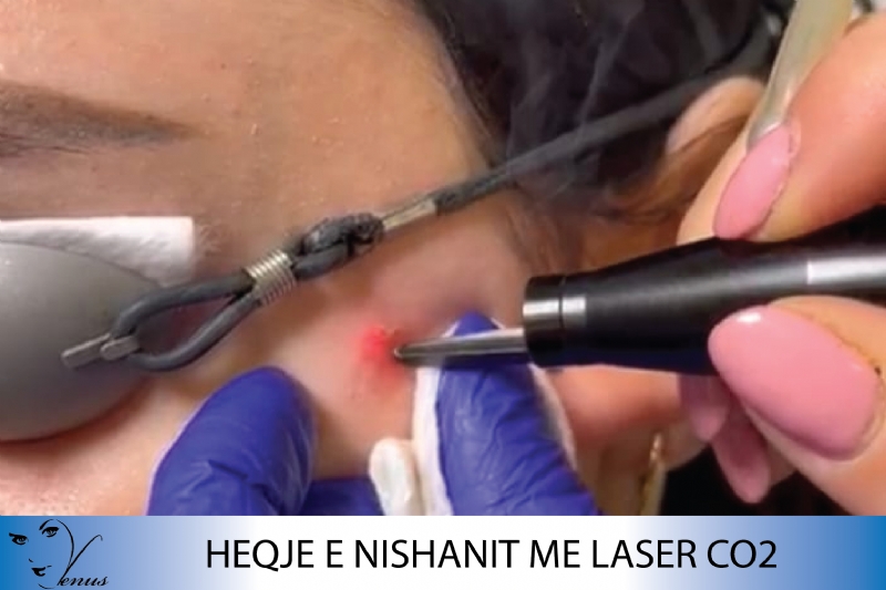 Heqje nishanit me Laser CO2, Heqje nishanesh me Laser, Heqje qimesh me Laserr Alexandri ne menyre permanente, Skin tag removal, Blu & red light, for acne & collagen stimulation, Shkrirja e dhjamit te gushes me Ac Deoxycolic